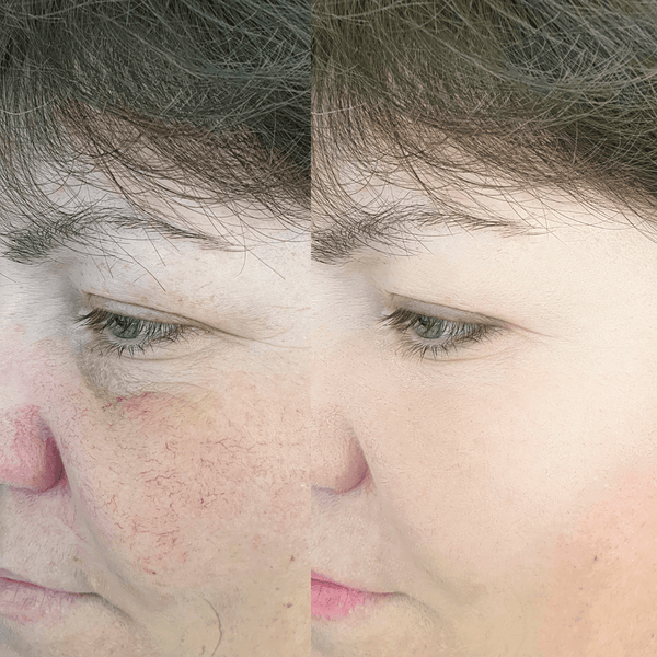 Red Light Therapy Before and After: What to Expect